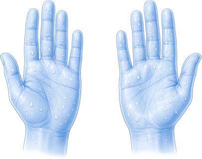 Illustration of hyperhidrosis